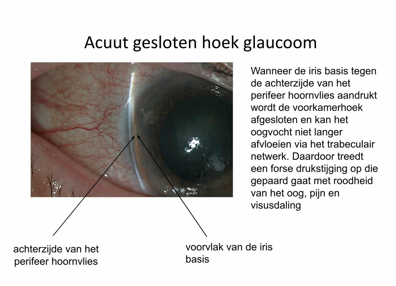 Pijnlijk rood oog in een patiënt met acuut gesloten hoek glaucoom