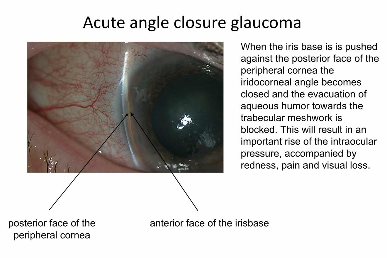 Red and painful eye in a patient with acute angle closure glaucoma