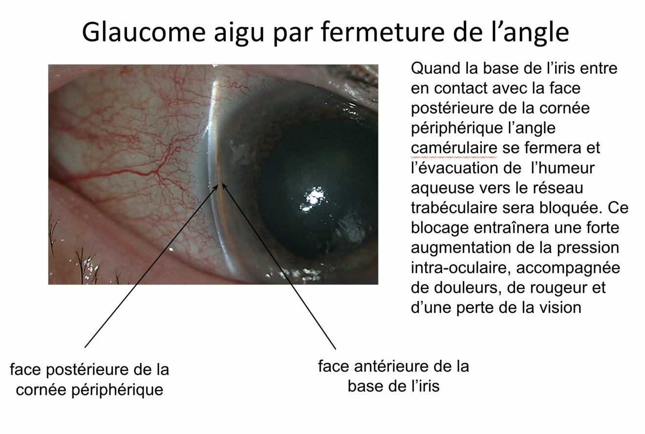 Oeil rouge et douloureux chez un patient avec un glaucome aigu par fermeture de l'angle