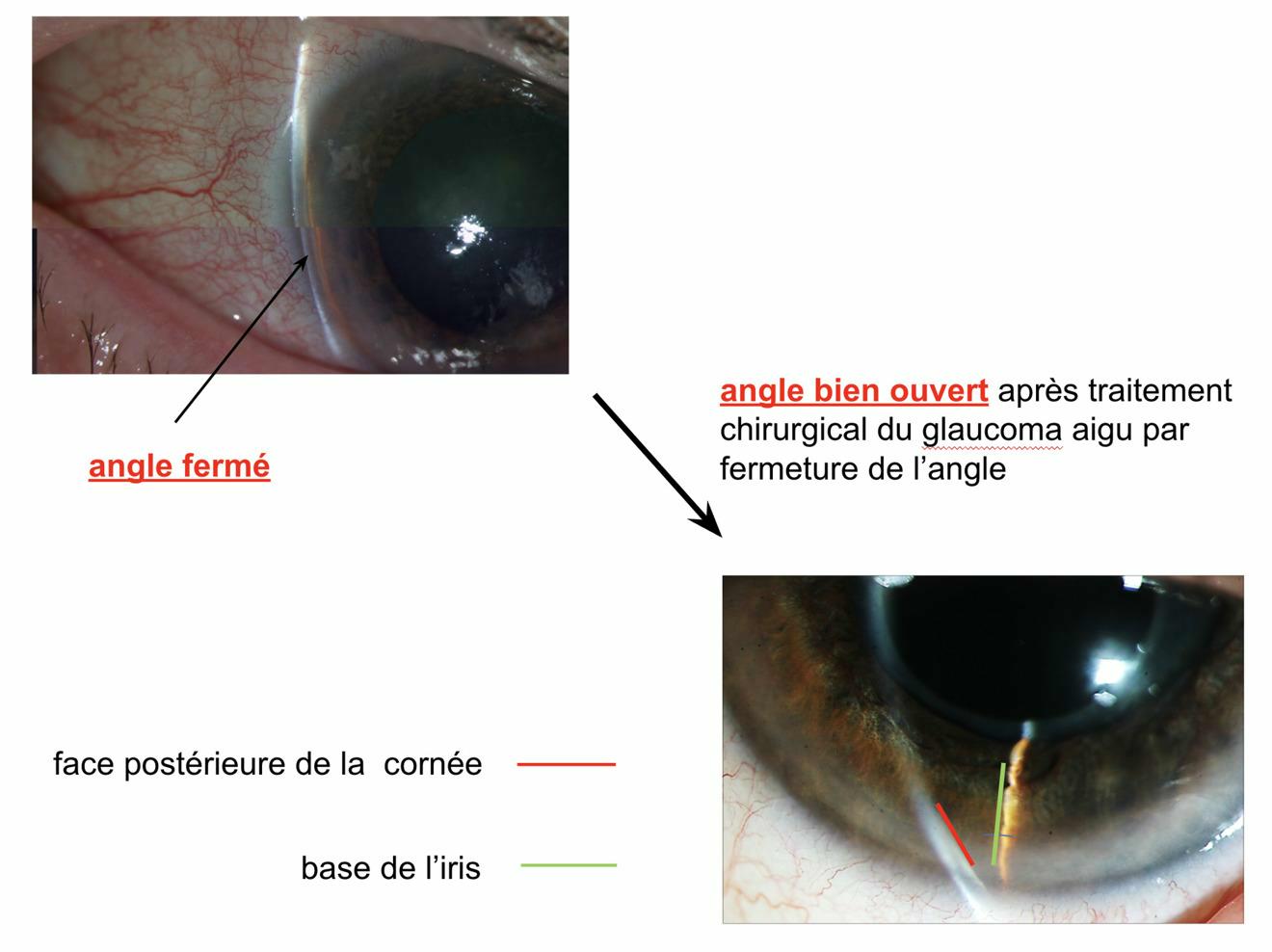 Glaucome aigu à angle fermé après traitement